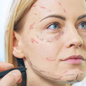 جراحة شد الوجه في إيران (الريتيدكتومي)