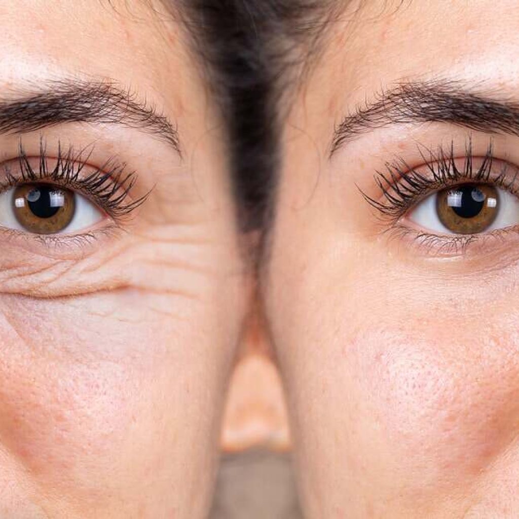 عملية تجميل الجفن السفلي بدون خياطة