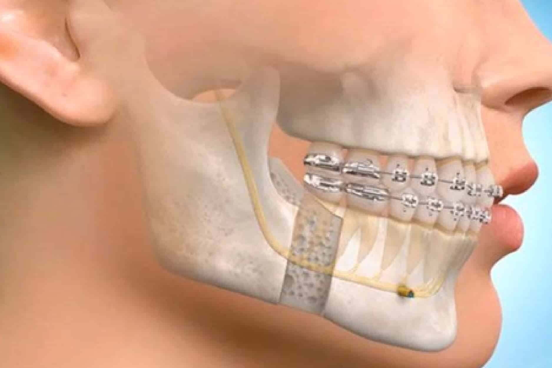 جراحة تجميل الفك في إيران