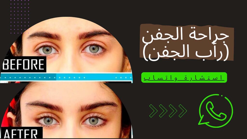 جراحة للجفن في إيران