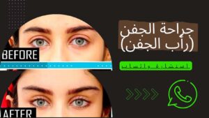 جراحة للجفن في إيران