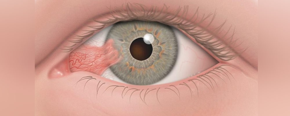 علاج ظفرة العين في إيران: دليل شامل للعلاج الفعّال والتكاليف المعقولة