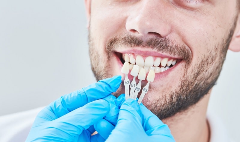 5 أشياء يجب أن تعرفها قبل تركيب فينير الاسنان