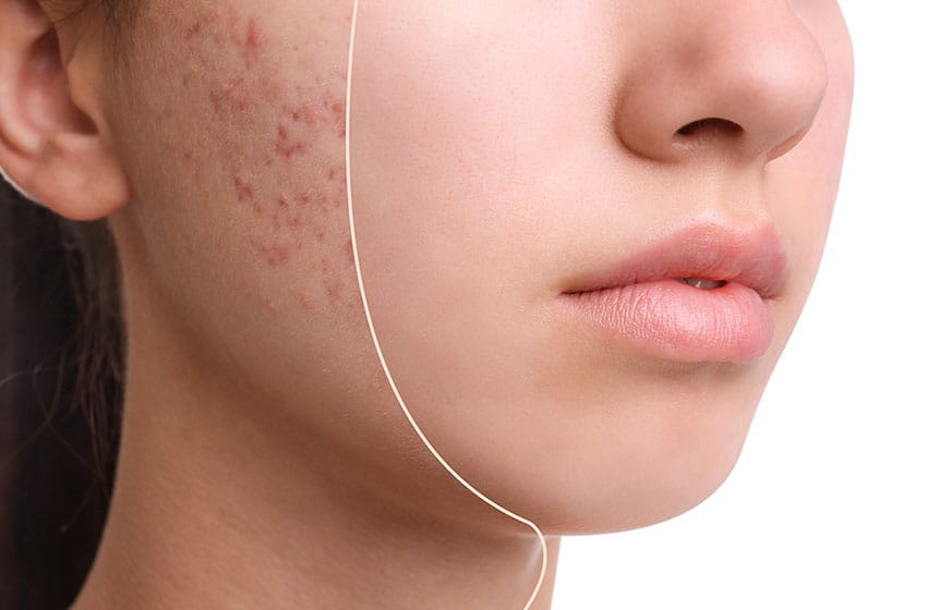 15 طريقة للتخلص من حب الشباب (البثور) دون عمليات تجميل