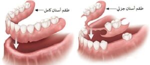 طقم الاسنان في ايران
