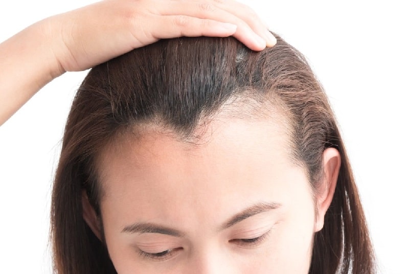 hairline-lowering-for-receding-hairline (1)