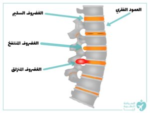 جراحة الانزلاق الغضروفي في إيران مع همين تور: استعادة راحتك بأسعار معقولة