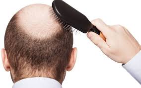 تساقط الشعر وزراعة الشعر في إيران مع همینتور