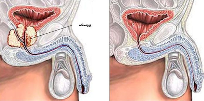 لماذا تختار إيران لعلاج سرطان البروستاتا؟