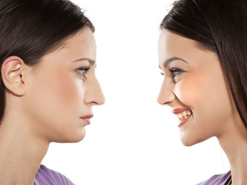 جراحة الأنف التجميلية في إيران: الوجهة المثالية للجمال