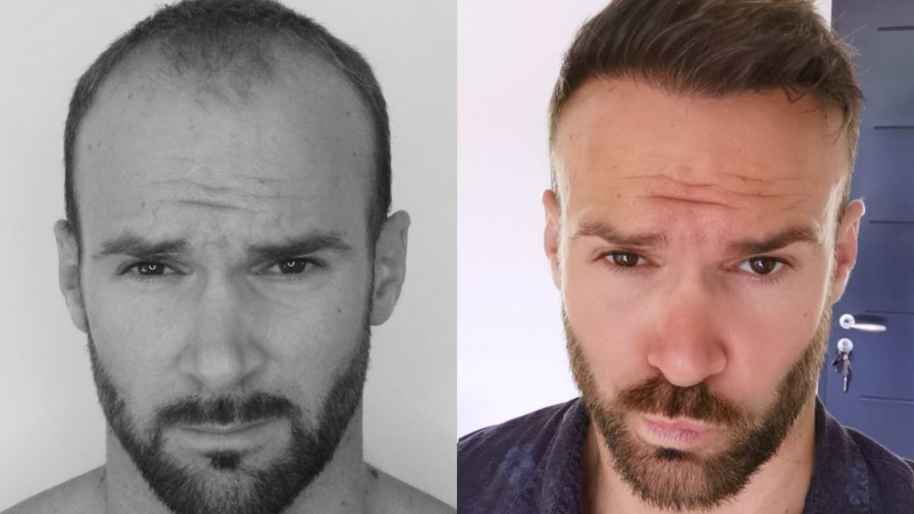 تكاليف زراعة الشعر ونصائح التخطيط المالي
