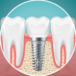 Dental Implant Recovery Guide with hamintour: Post-Operative Instructions