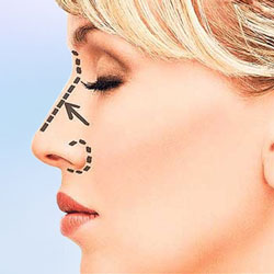 Ideal Rhinoplasty Styles for Stunning Results