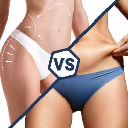COOLSCULPTING VS LIPOSUCTION: WHICH IS BETTER?