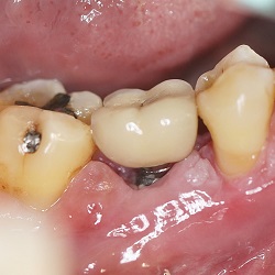 DENTAL IMPLANT INFECTION: CAUSES AND TREATMENTS
