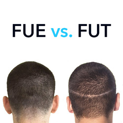 FUE vs. FUT Hair Transplant: Which is Right for You?