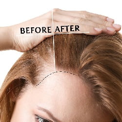 Hairline lowering vs. hair transplant: what is the difference?