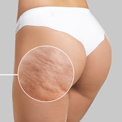 6 Effective Treatments to Reduce Cellulite with Hamintour