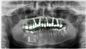 Dental OPG: Revolutionizing Oral Health Diagnostics