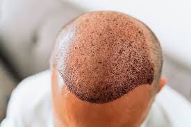 كل شيء عن طرق زراعة الشعر: FUE، FUT وأكثر