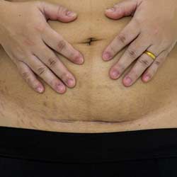 Minimizing Weight Loss Surgery Scarring with hamintour: A Comprehensive Guide
