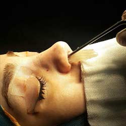 ALL YOU NEED TO KNOW ABOUT NASAL PACKING AFTER RHINOPLASTY