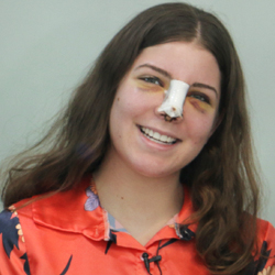 ALL YOU NEED TO KNOW ABOUT RHINOPLASTY RECOVERY: A SIMPLE GUIDE
