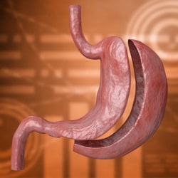 Gastric Bypass vs. Gastric Sleeve: A Comprehensive Comparison