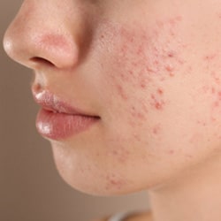 15 Ways to Get Rid of Acne (Pimples) Without Cosmetic Procedures