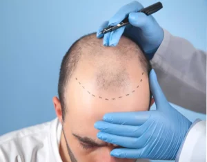 أفضل عيادات زراعة الشعر في إيران