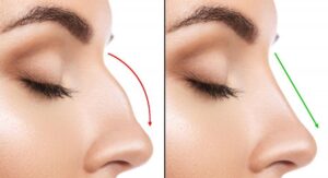 🌟 Best Rhinoplasty Surgeons in Mashhad, Iran