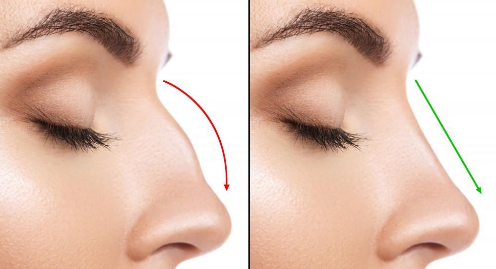 🌟 Best Rhinoplasty Surgeons in Mashhad, Iran