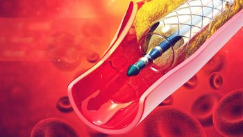 Angioplasty in Iran: Affordable Heart Treatment
