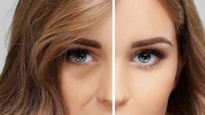 Revitalize Your Eyes with Eyelid Surgery in Iran