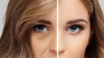 Revitalize Your Eyes with Eyelid Surgery in Iran