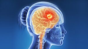 Brain Cancer Treatment
