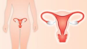 Cervical Cancer Treatment