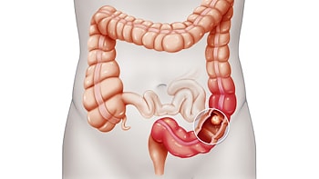 Colon Cancer Treatment