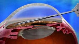 Premier Glaucoma Treatment in Iran