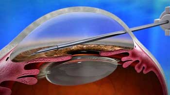 Premier Glaucoma Treatment in Iran