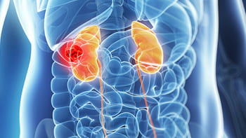 Iran's Cutting-Edge Kidney Cancer Care