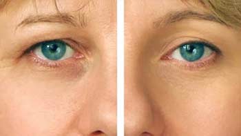Transform Your Appearance with Oculoplastic Surgery in Iran