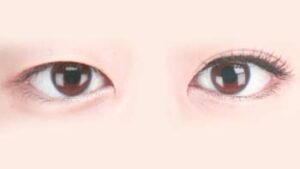 Oriental Eyelid Surgery in Iran