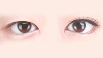 Oriental Eyelid Surgery in Iran