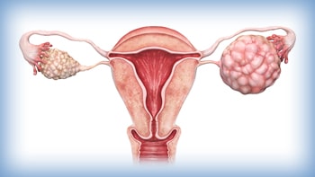 Iran's Leading Ovarian Cancer Solutions