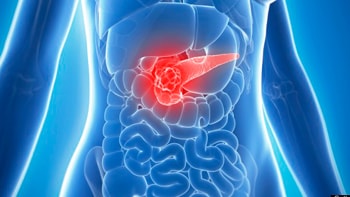 Comprehensive Guide to Pancreatic Cancer Treatment in Iran: Precision and Hope