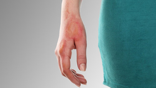 Restoring Confidence: Reconstructive Burn Surgery in Iran