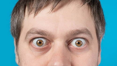Effective Exophthalmos Treatment in Iran