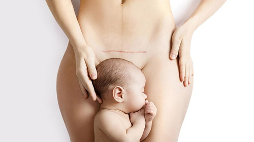 Caesarean Section in Iran