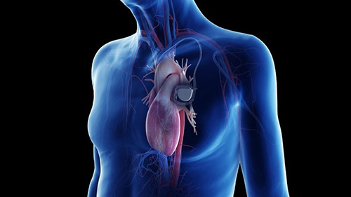Pacemaker Surgery in Iran: Affordable and Expert Care